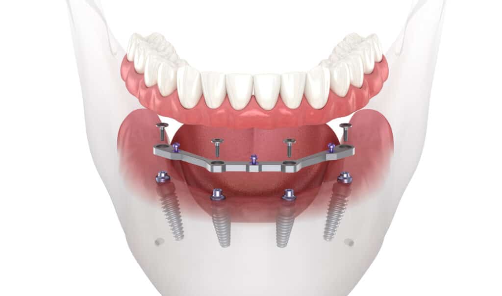 Mandibular prosthesis with gum All on 4 system supported by implants. Medically accurate 3D illustration
