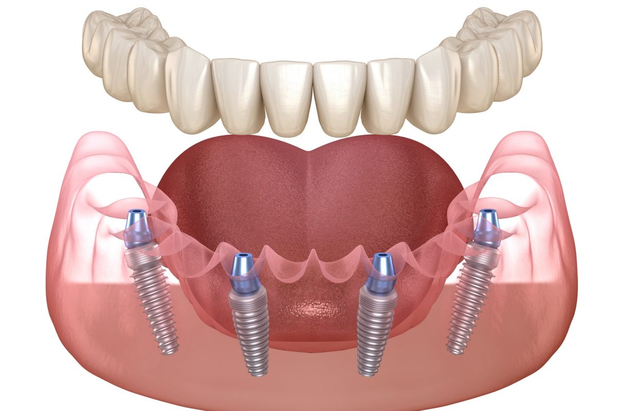 Mandibular prosthesis All on 4 system supported by implants. Medically accurate 3D illustration of human teeth and dentures concept